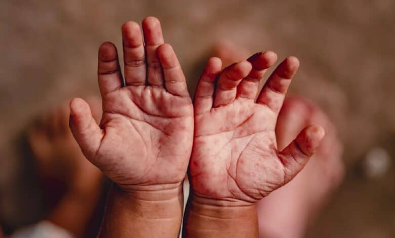 Health department calls for calm amid spread of HFMD